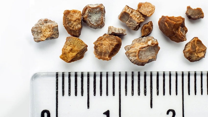  Office Procedure Found to Get Stone Fragments Rolling