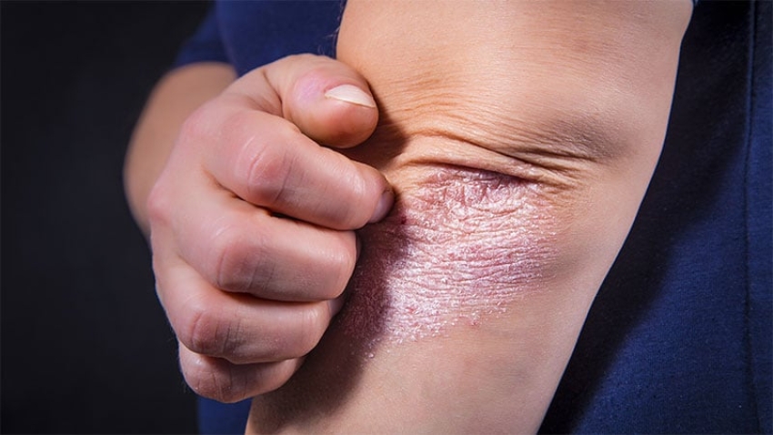 IL-23 Inhibitors Show Highest Drug Survival in Psoriasis
