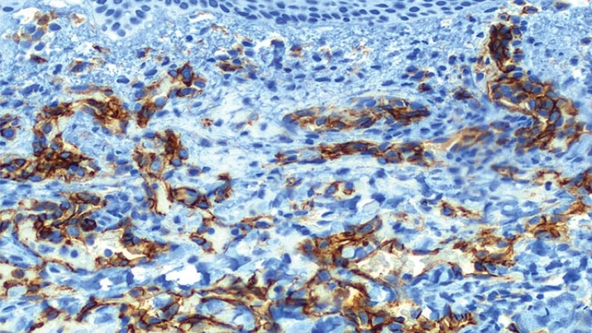 DIF Microscopy Helps Diagnose Pediatric Skin Diseases