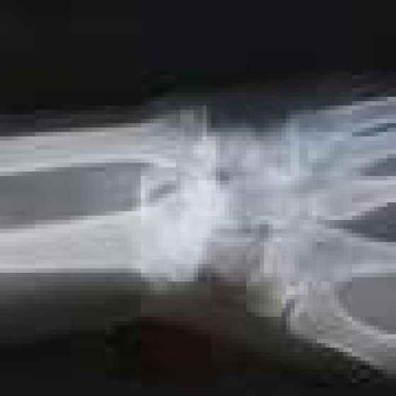 New research reveals genetic link to most common pediatric bone cancer