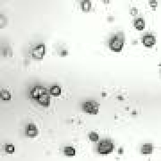 Two genes found to suppress colorectal cancer spread in preclinical models