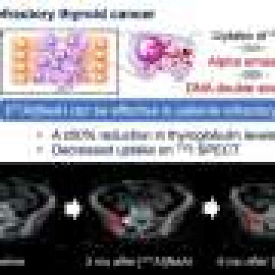 Targeted alpha therapy using astatine shows promise in thyroid cancer resistant to conventional treatment