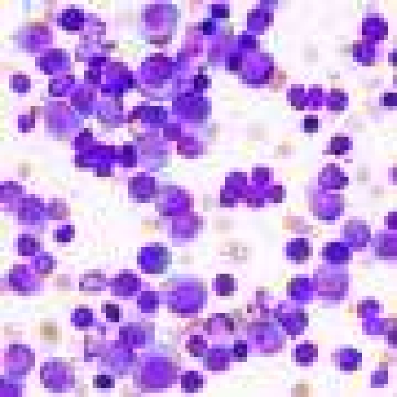 Combination treatment shows large improvement in survival for people with relapsed myeloma