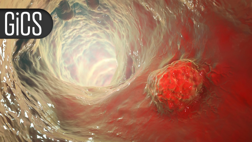 Regular Physical Activity Thwarts Fatigue, Boosts QoL in Colorectal Cancer