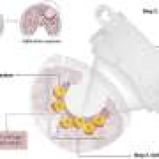 Focused ultrasound for glioblastoma (GBM): Clinical results and follow-on trial in Taiwan